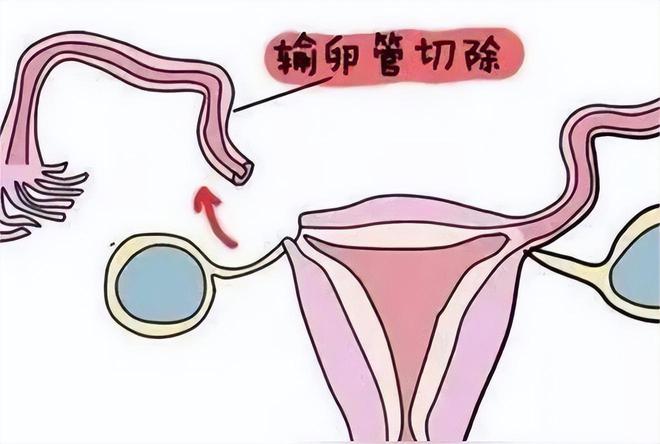 捐卵女孩