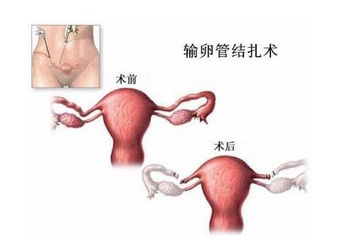 东莞供卵机构