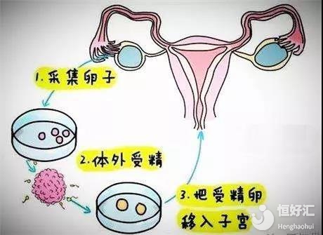 贺州捐卵补偿